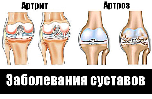 Артрит тест с ответами. Чем отличается артрит от артроза суставов.